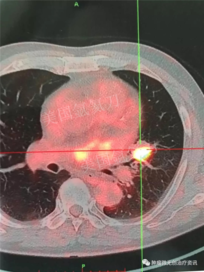 煤炭总医院氩氦刀冷冻消融治疗左肺小细胞癌