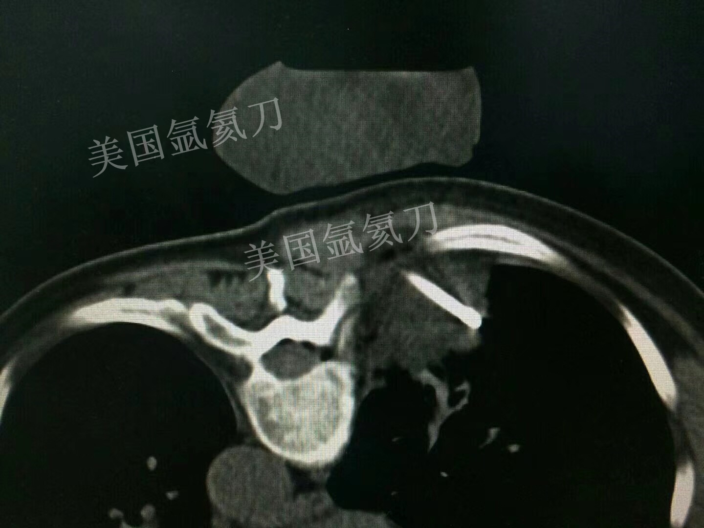 武清中医院胸外科胸壁肿瘤氩氦刀冷冻消融手术​