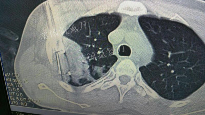 307医院肿瘤微创中心肺转移癌氩氦刀冷冻手术