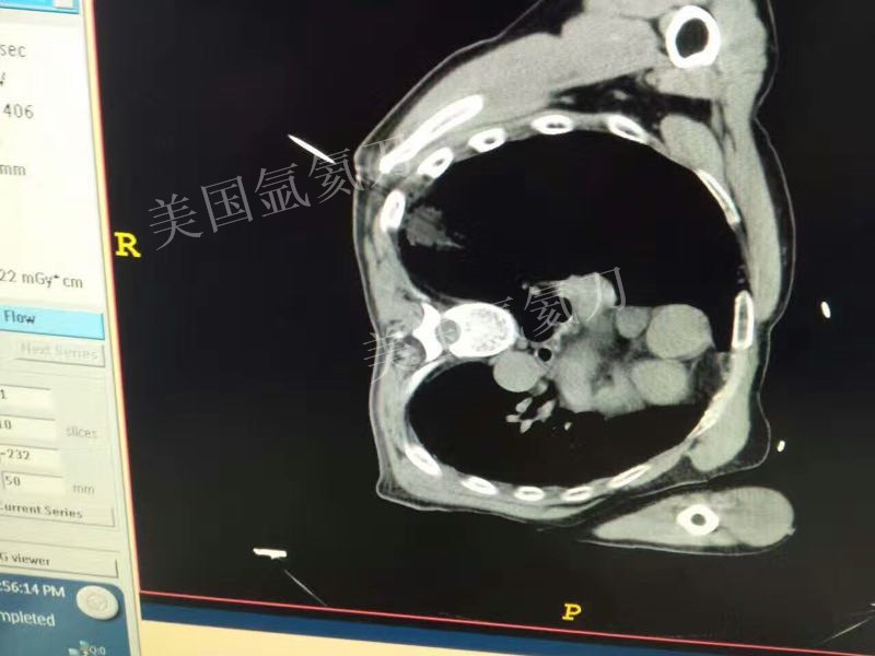 北京陆军总医院胸外科肺癌氩氦刀冷冻手术