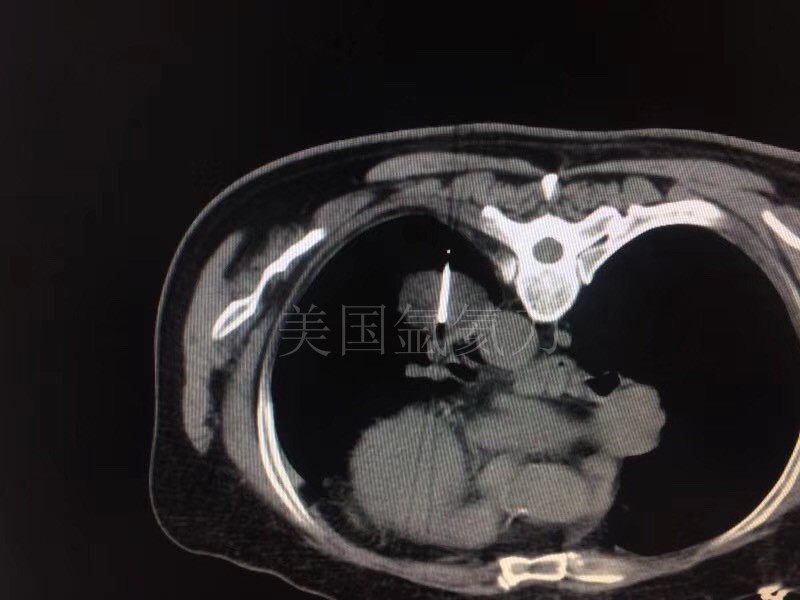 北京陆军总医院胸外科一台氩氦刀冷冻肺癌手术