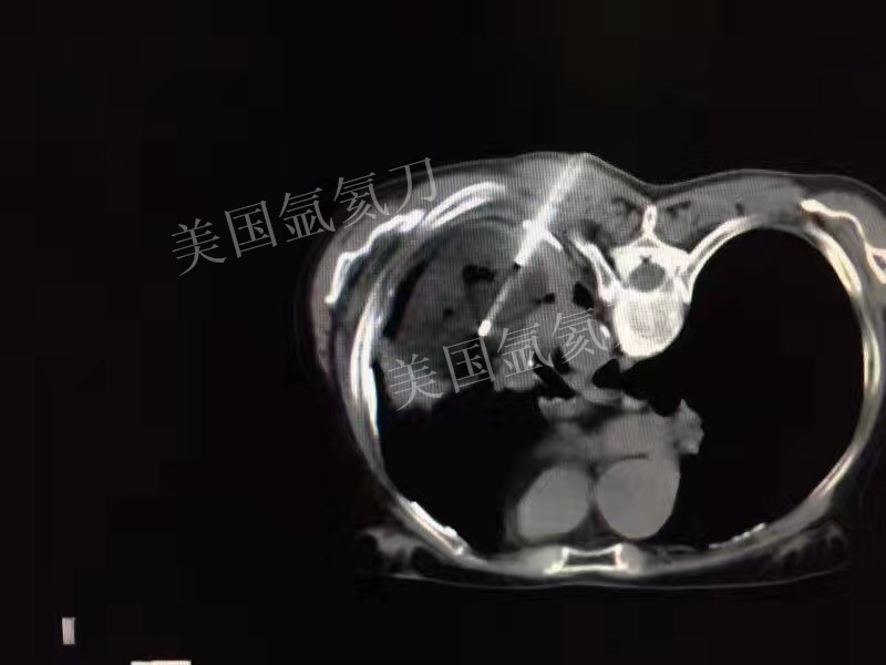 北京陆军总院胸外科肺癌氩氦刀冷冻消融治疗