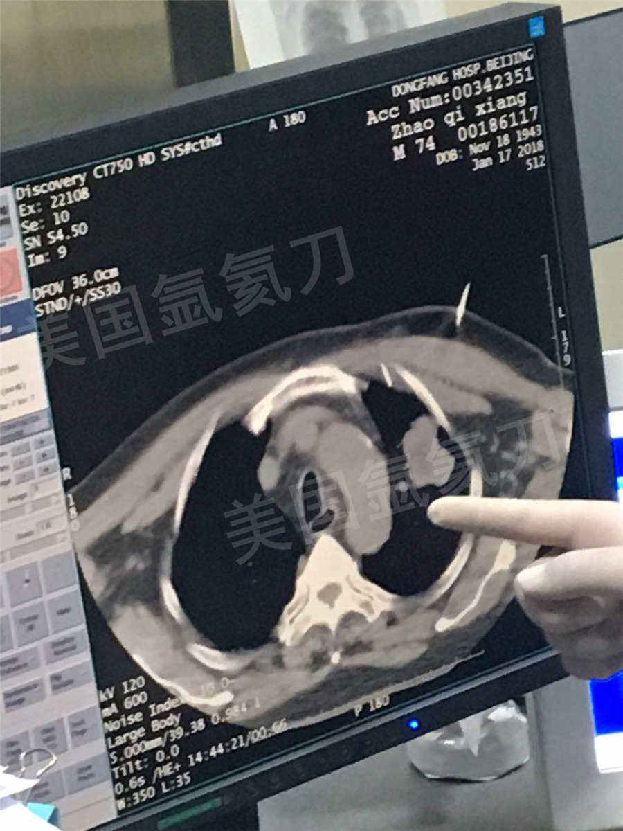 东方医院一台肺癌氩氦刀手术