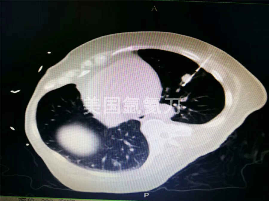 华北石油总医院做的三台肺癌氩氦刀冷冻手术