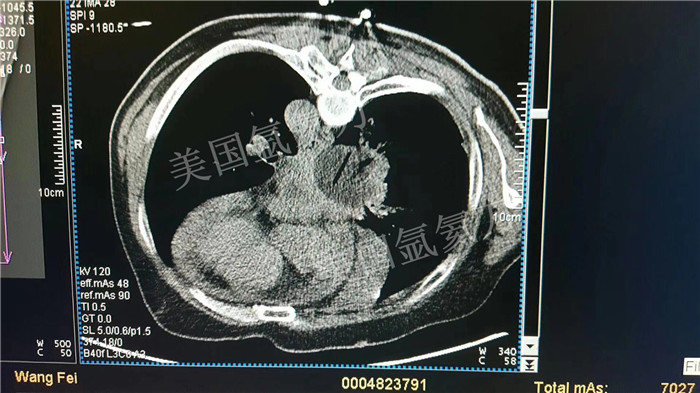 北京陆军总医院胸外科氩氦刀肺癌冷冻手术