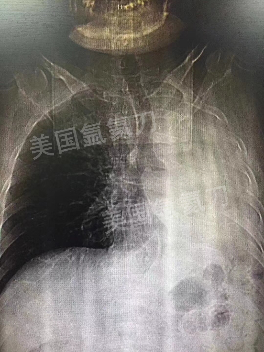 武清中医院胸外科肺部氩氦刀治疗