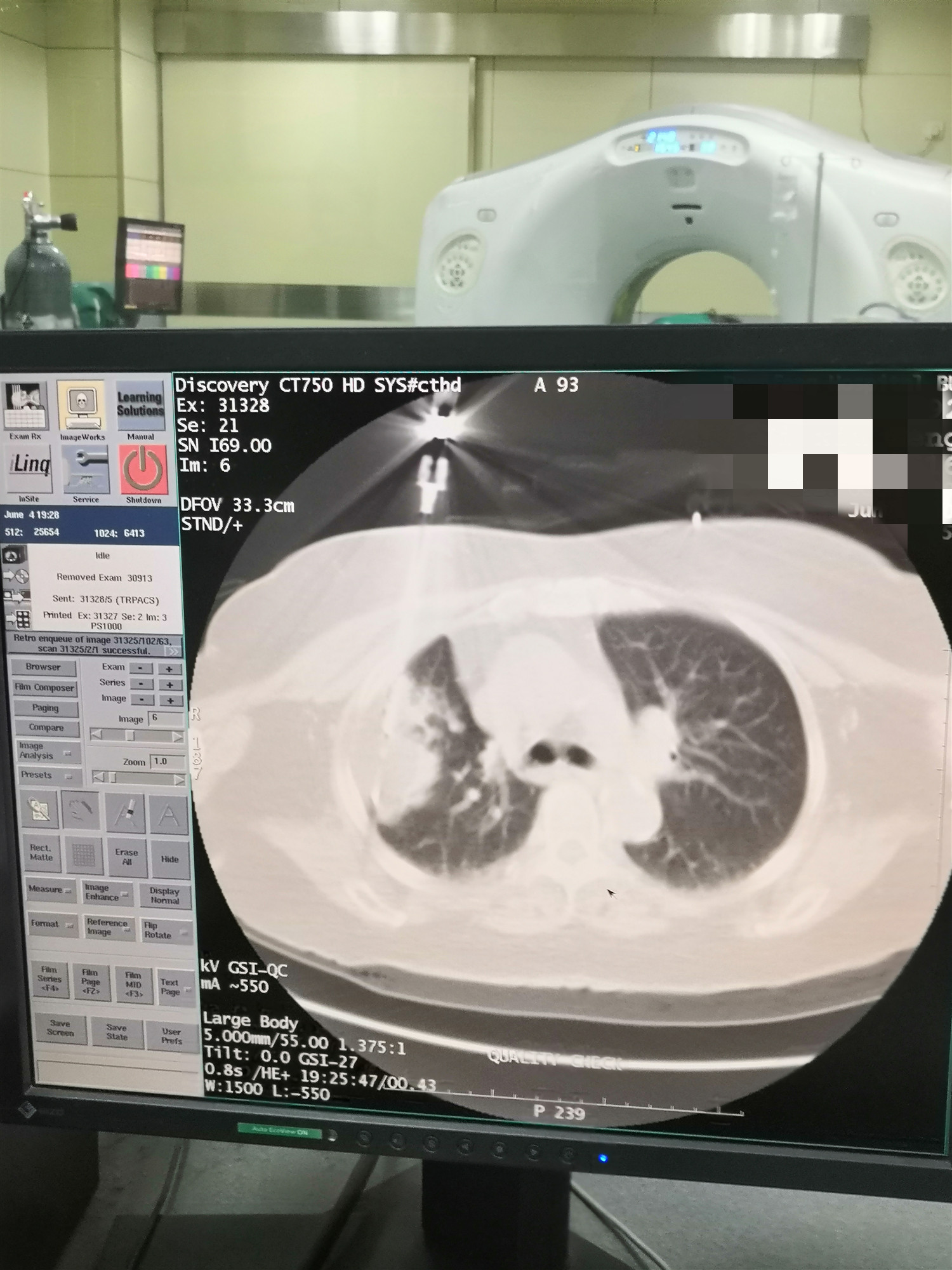 2019.6月肺部氩氦刀手术