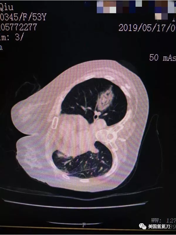 2019.5月肺部氩氦刀手术