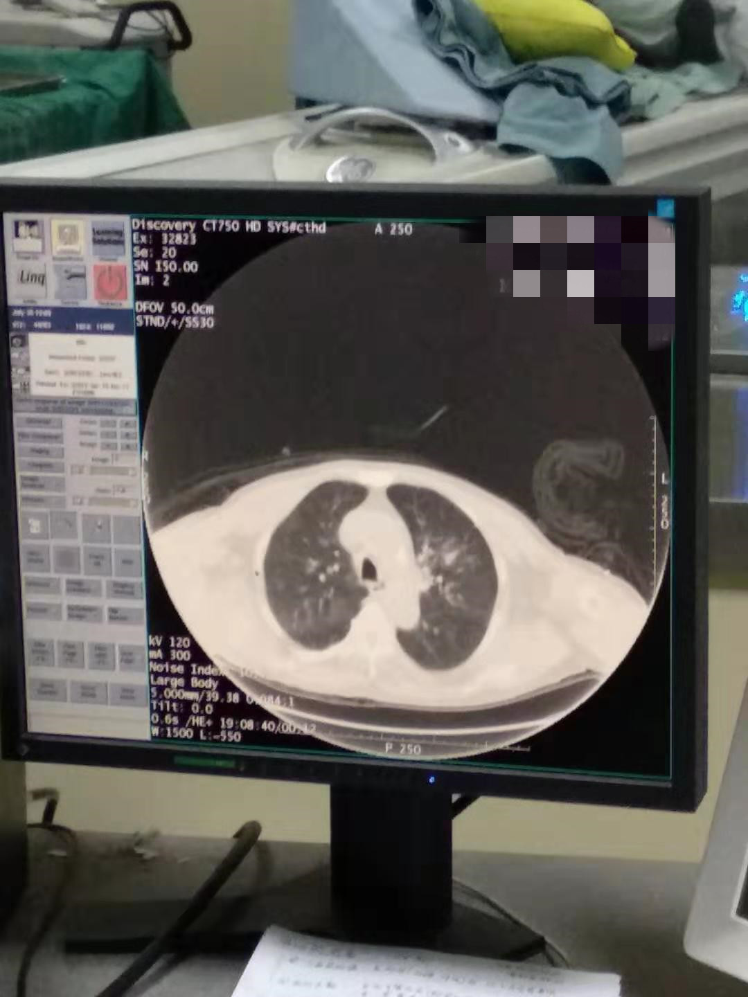 2019.7月肺部氩氦刀手术