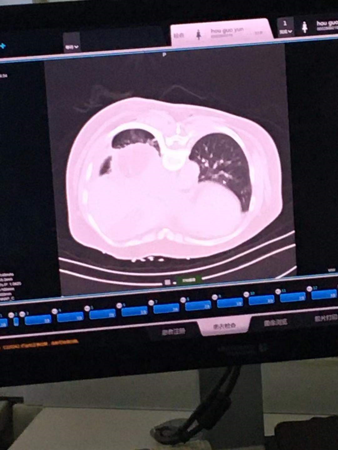 2019.11月肺部氩氦刀手术