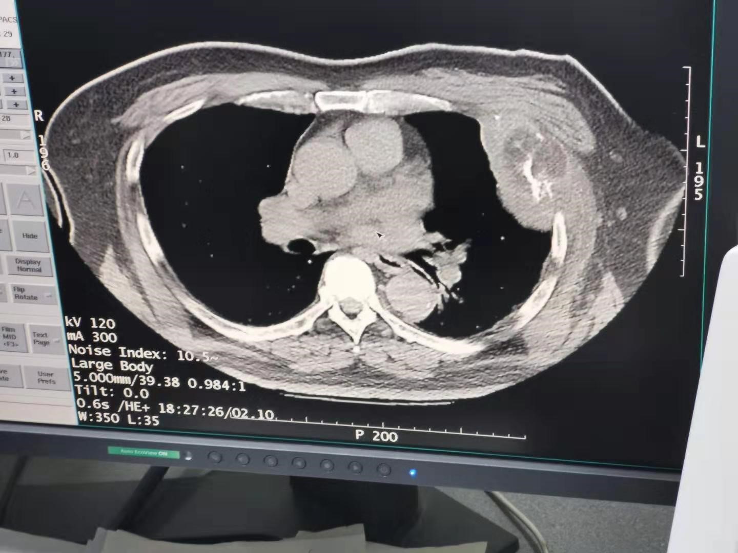 2019.12月肺部氩氦刀手术