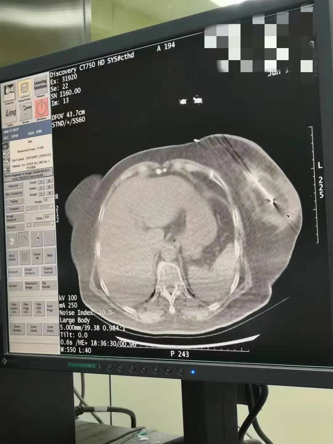 2019.6月胸腺氩氦刀手术