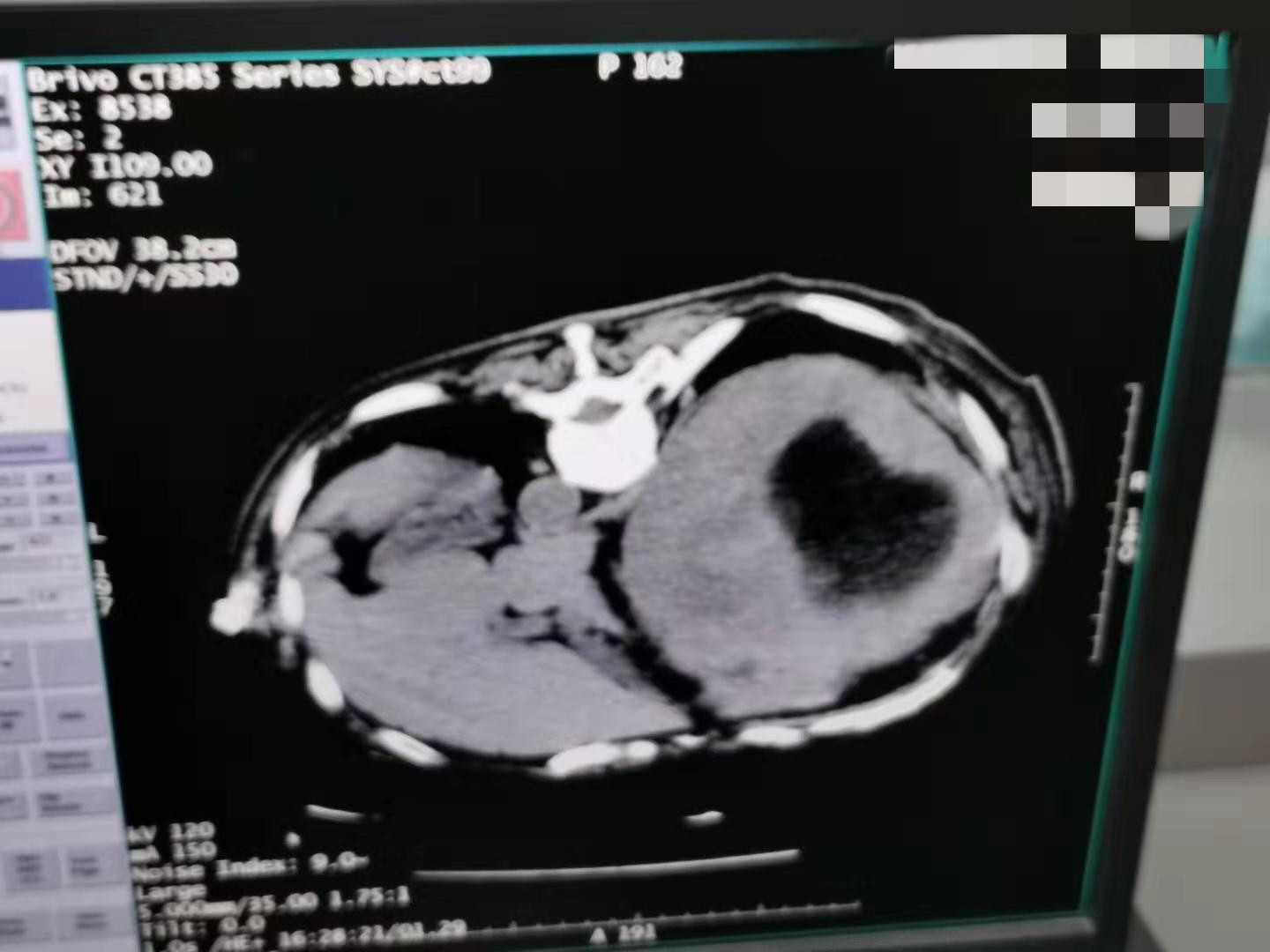 2019.10月腹膜肉瘤氩氦刀手术