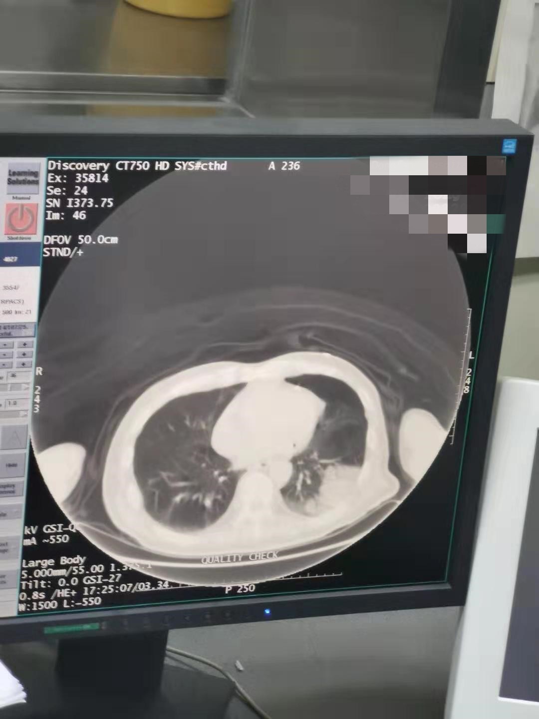 2020.1月左肺下叶氩氦刀手术