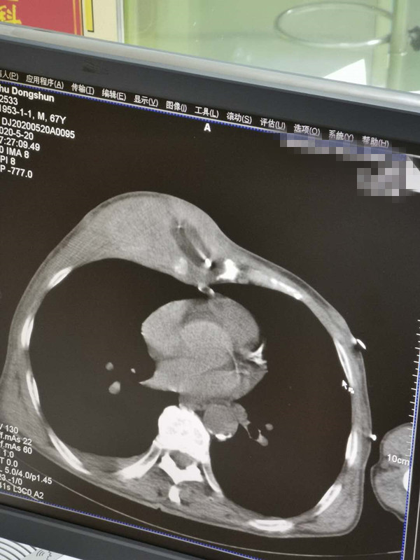 2020.5月胸部肉瘤氩氦刀手术