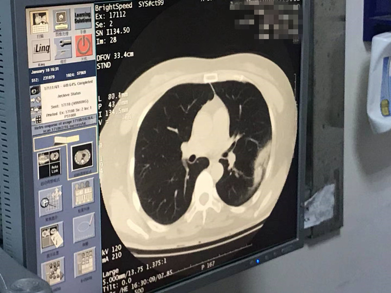 2021.1月肺部氩氦刀手术