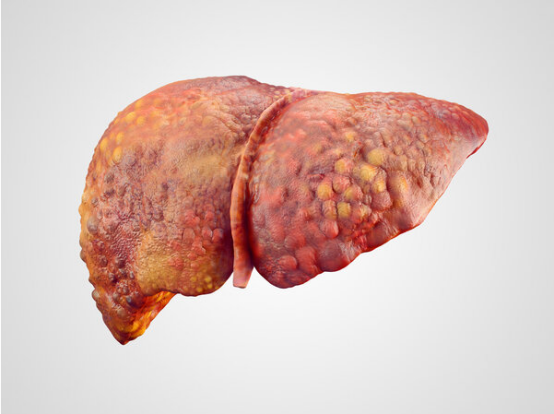 从肝炎到肝癌只有3步！远离肝癌，你千万不能做的5件事