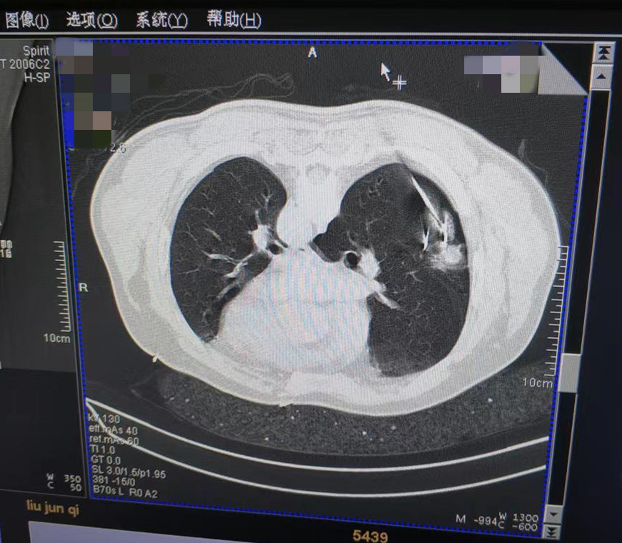 2022.7月肺部氩氦刀手术