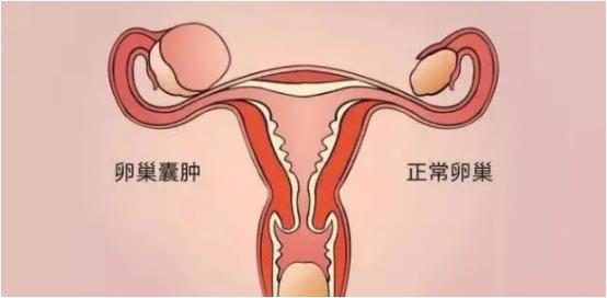 生育与女性肿瘤发病的关系