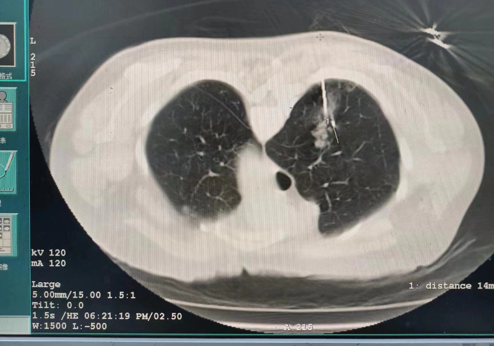 2023.2月份肺部氩氦刀手术